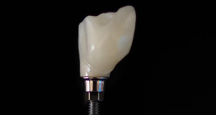 A porcelain crown on an implant abutment.